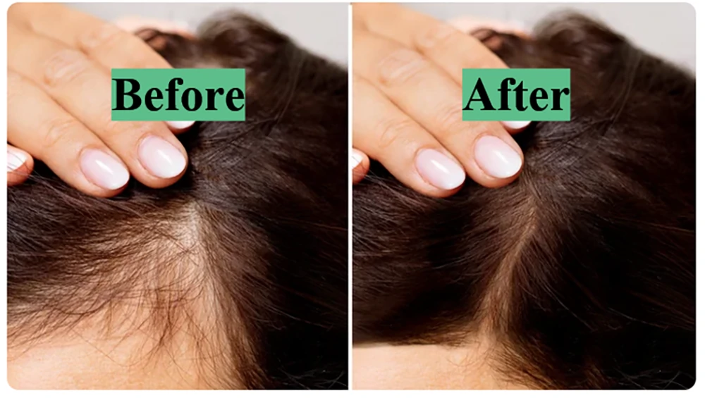 Laser 22 Hair Growth Cap